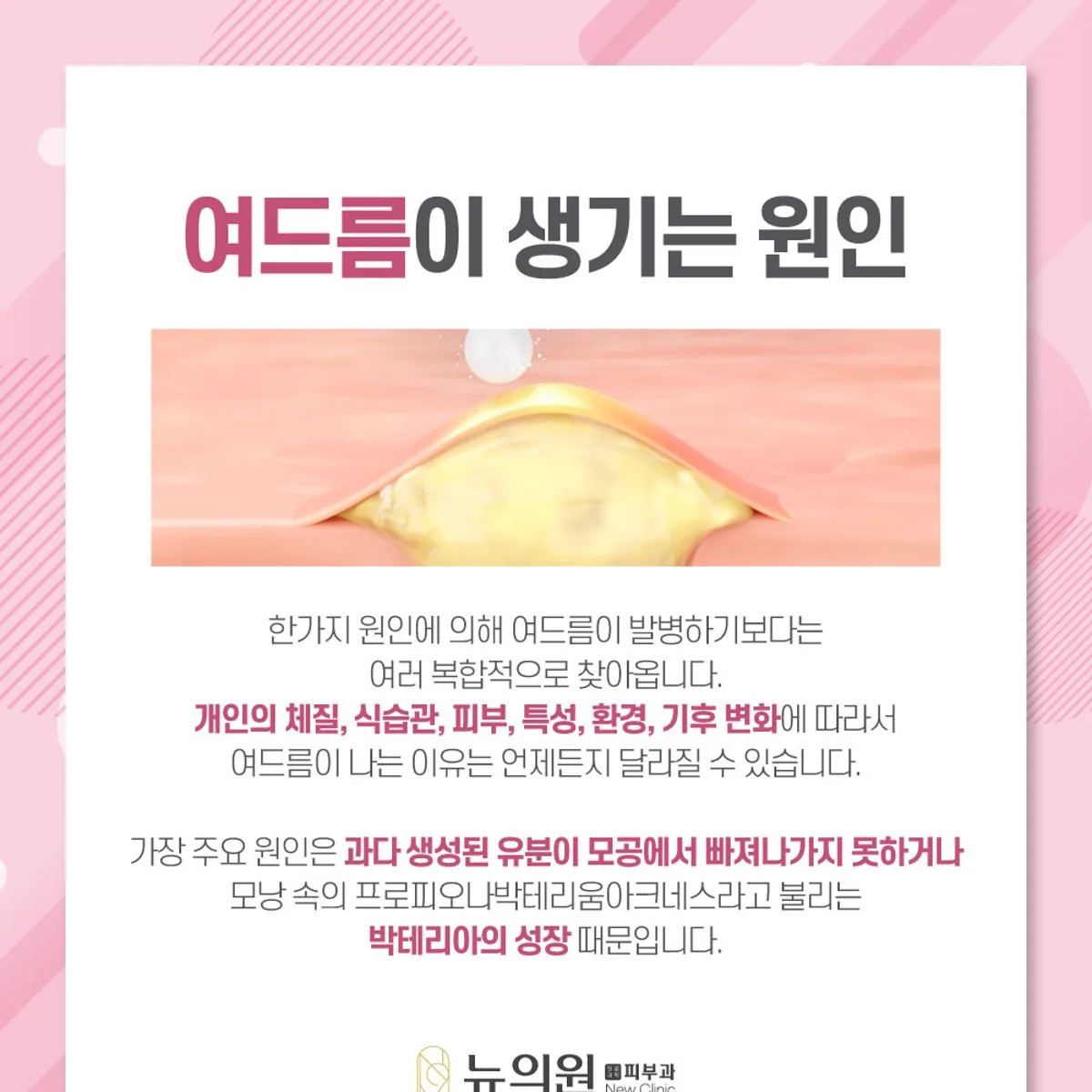 여드름이 생기는 원인을 정리한 뉴의원 안내 카드 이미지